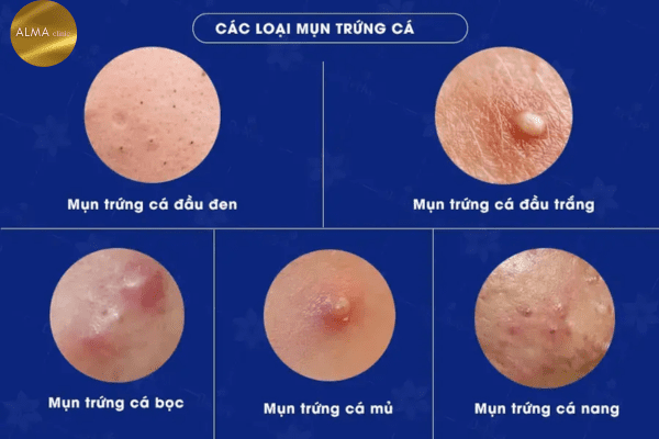 Phòng khám da liễu ALMA CLINIC 5 dieu can biet ve mun trung ca 1