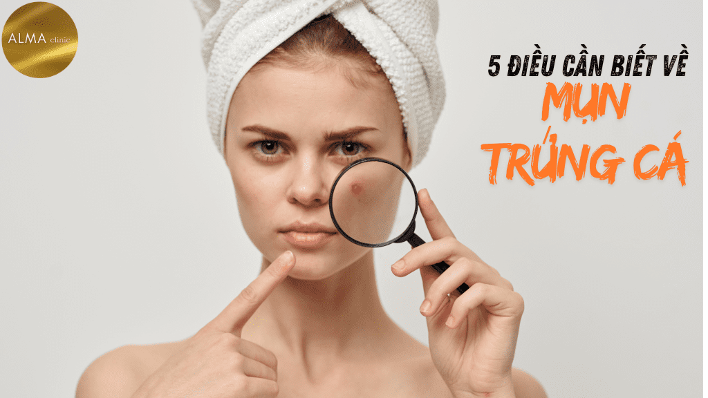 Phòng khám da liễu ALMA CLINIC 5 dieu can biet ve mun trung ca