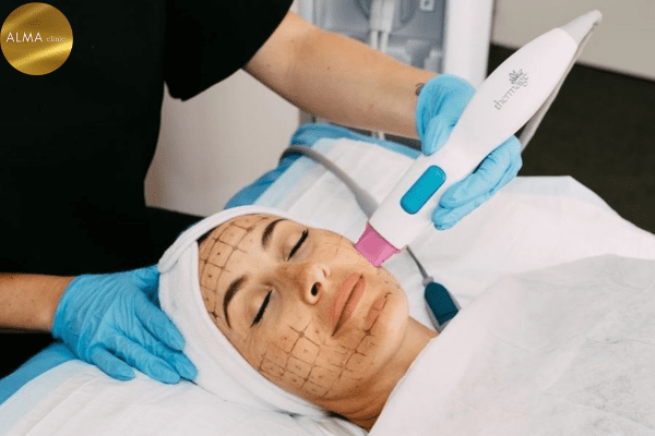 Phòng khám da liễu ALMA CLINIC phan biet dau tip thermage chinh hang