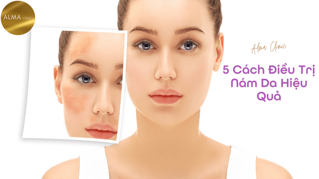 Phòng khám da liễu ALMA CLINIC 5 cach dieu tri nam da hieu qua