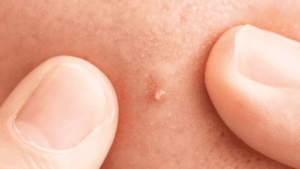 Phòng khám da liễu ALMA CLINIC mun dau trang