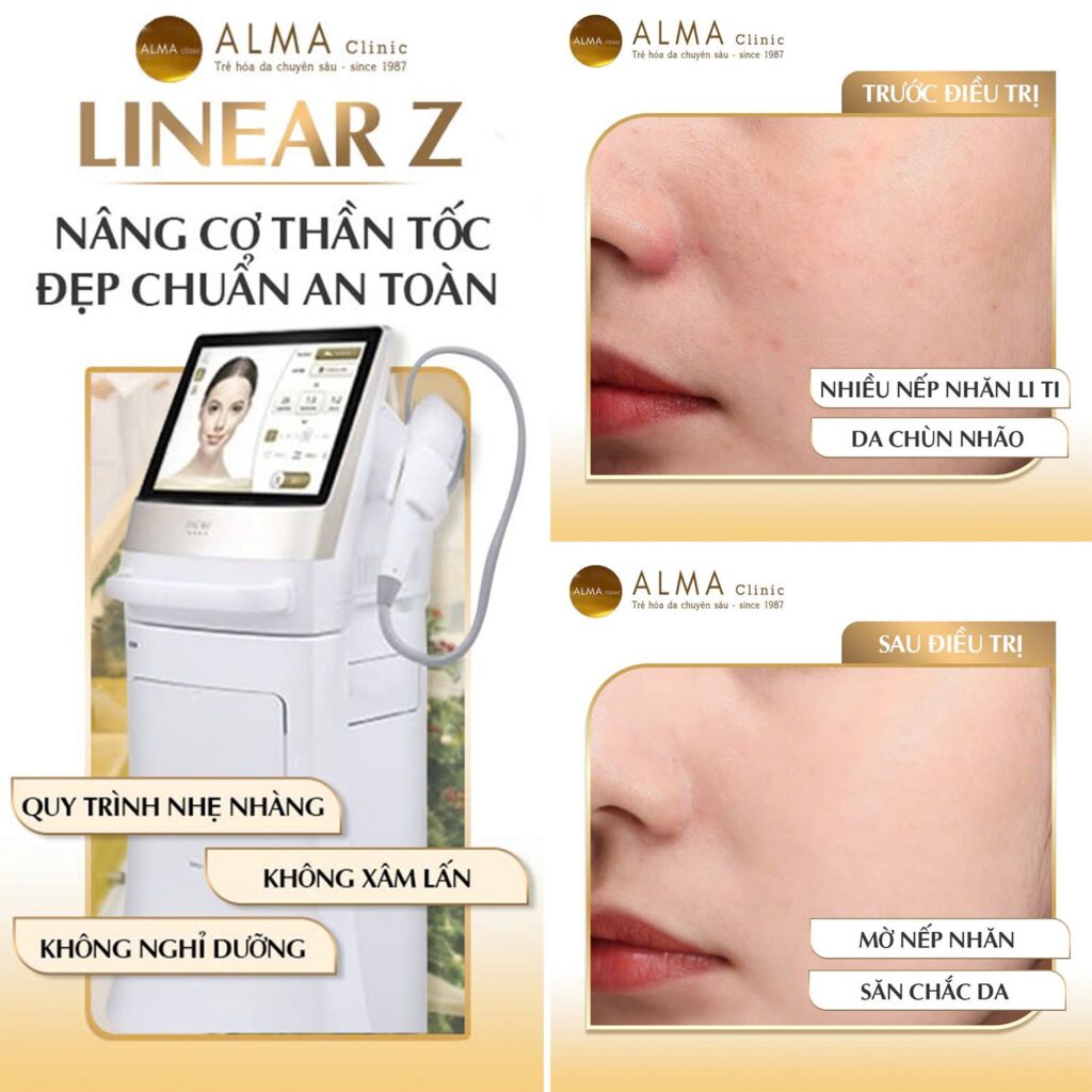 Linear Z – công nghệ HIFU thế hệ mới mang lại hiệu quả vượt trội