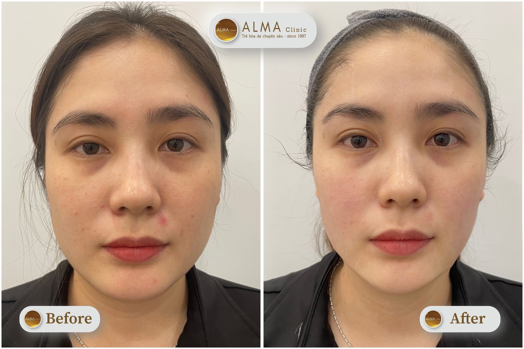 Một khách hàng tại Alma đã với liệu trình Linear Z.