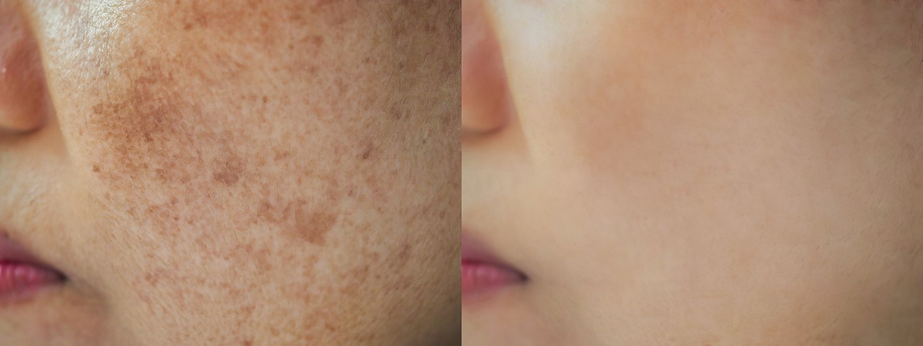 Nám mảng có chữa được không? Các trị nám mảng hiệu quả tại nhà