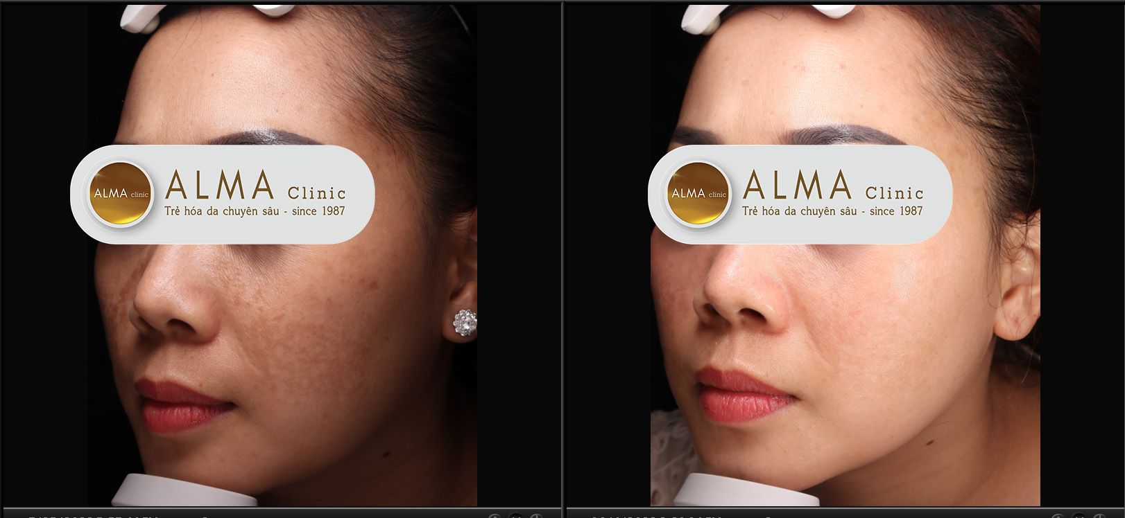 Chi Minh Anh 35 tuoi TPHCM Chị Minh Anh 35 tuổi TPHCM đã từng thử trị nám chân sâu tại nhà và phương pháp laser tại Alma Clinic