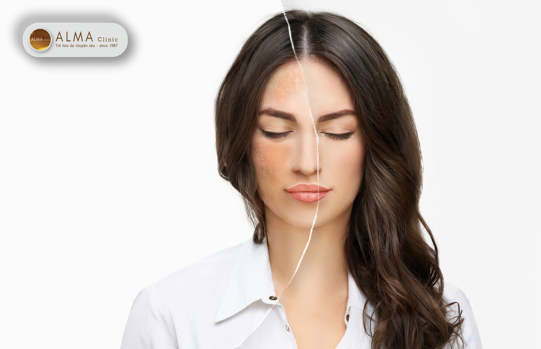 Hiểu rõ nguyên nhân hình thành nám sẽ giúp bạn tìm được phương pháp điều trị phù hợp