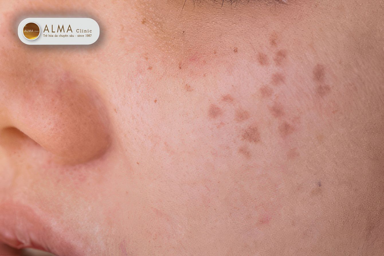 Phân biệt nám mảng và nám chân sâu: Nám chân sâu (tên tiếng anh Hori's Nevus)