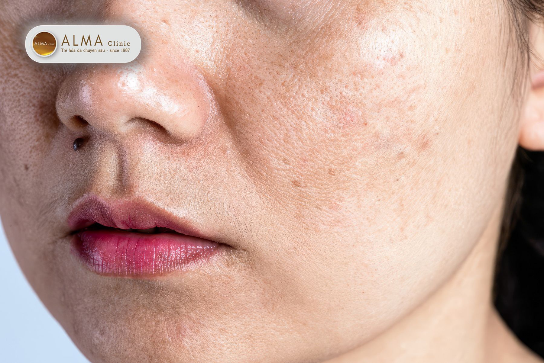 Phân biệt nám mảng và nám chân sâu: Nám mảng (tên tiếng anh: Melasma)
