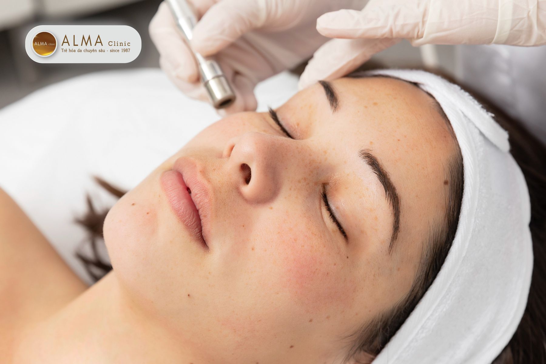 Quy trình lăn kim trị nám chuẩn y khoa