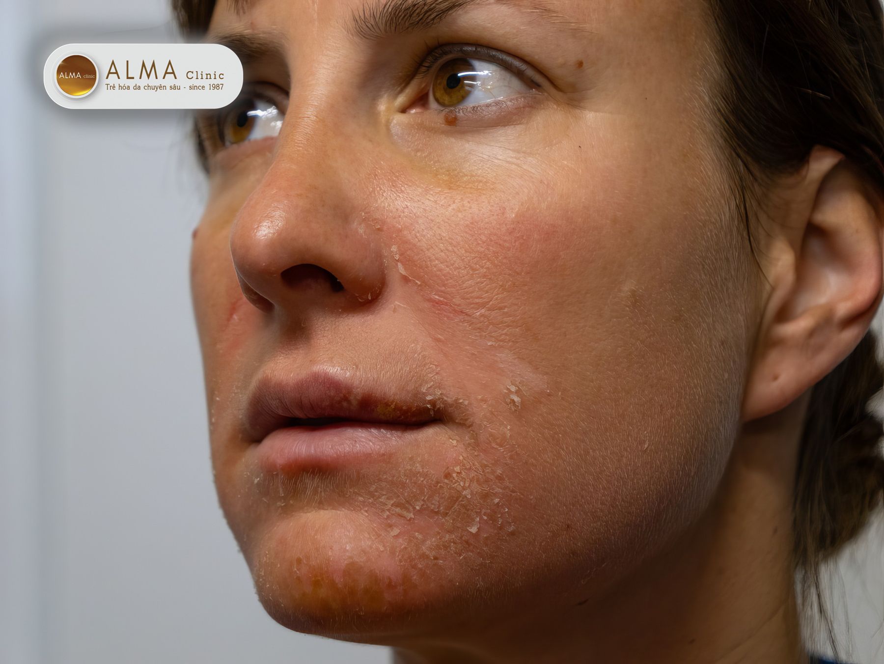 Trị nám tại nhà bằng lăn kim peel da tại nhà