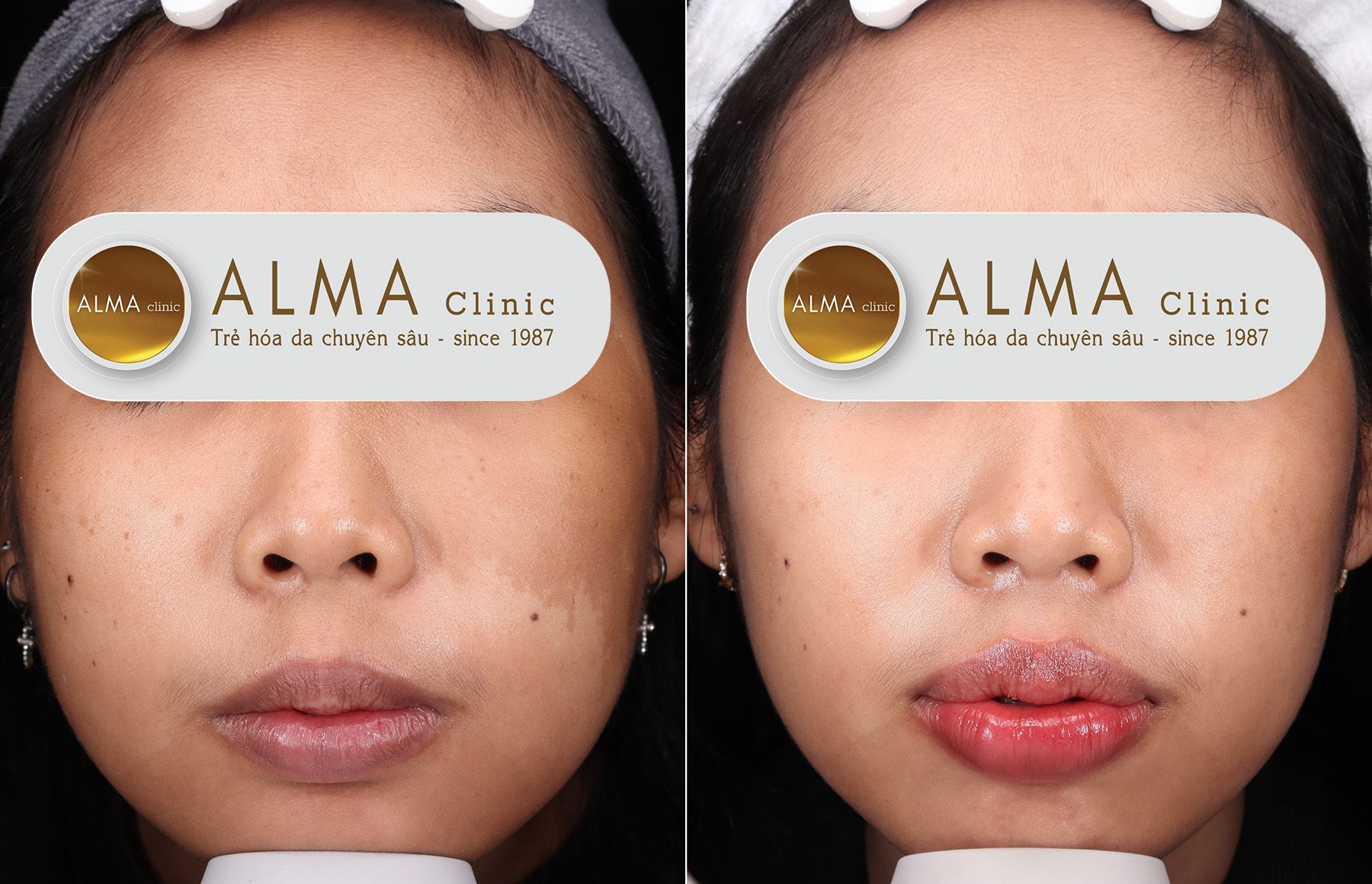 Khách hàng điều trị da nám tại Alma Clinic