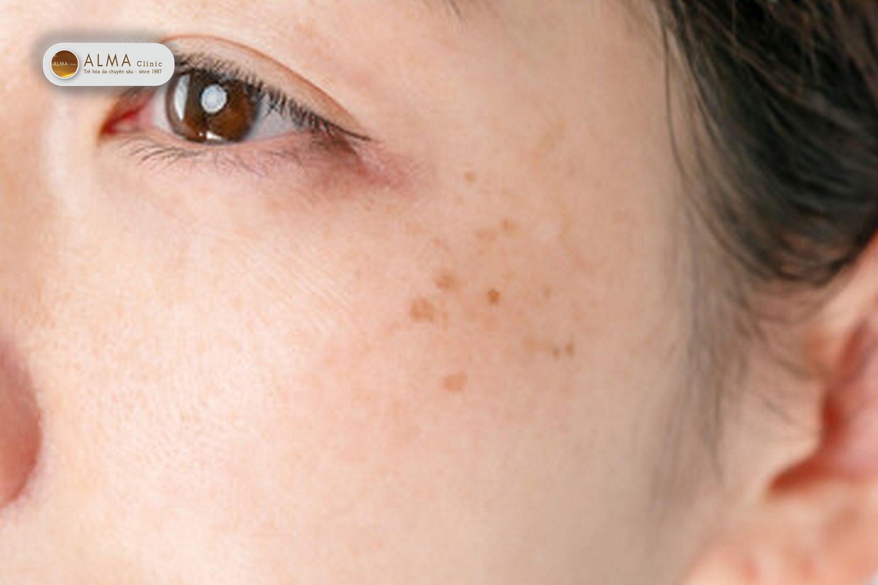 Liệu da mặt bị nám hết nám rồi có bị lại không?