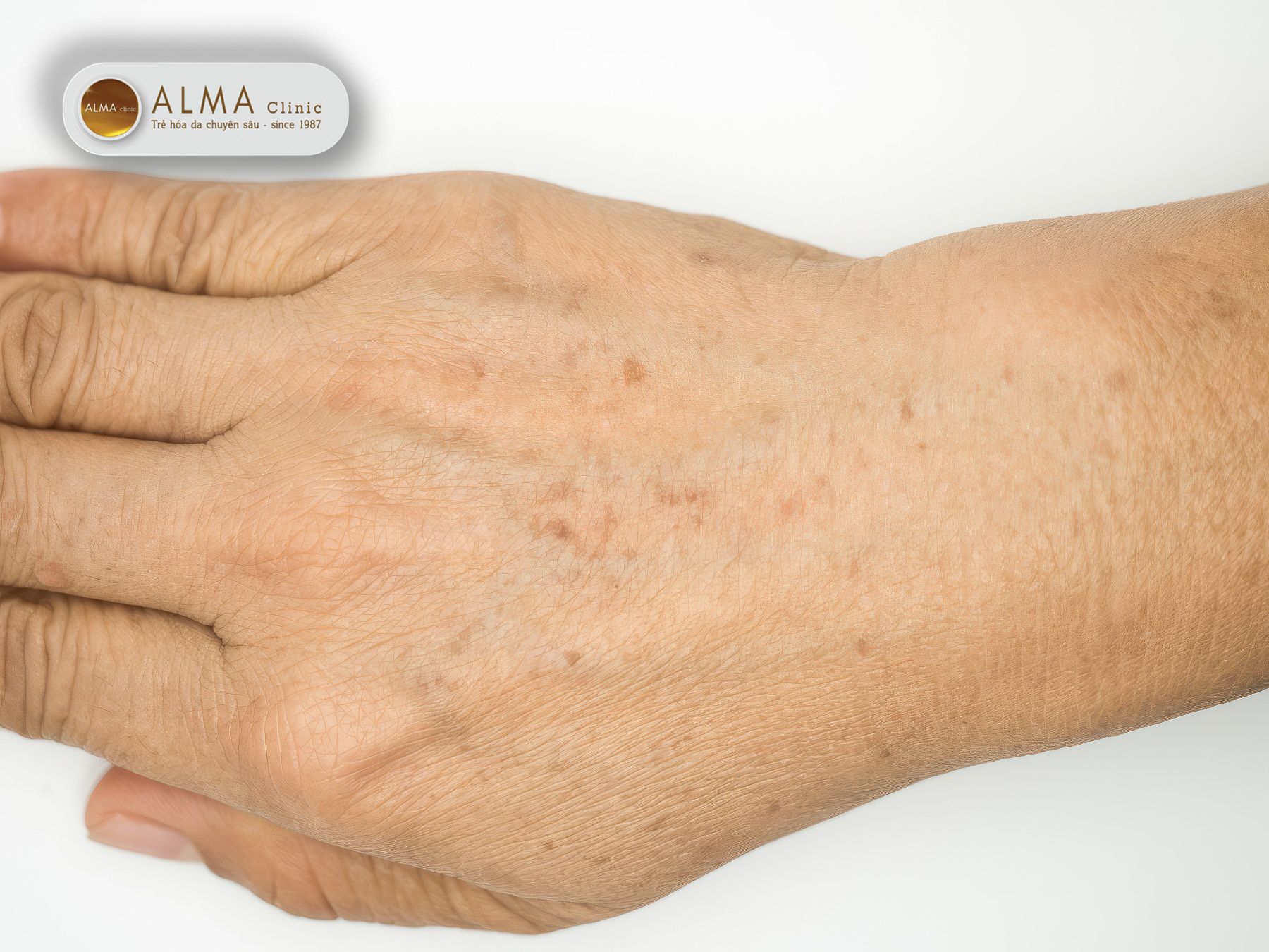 Nam o tay khien ve ngoai trong gia dan hon va su tu tin phan nao voi di Nám ở tay khiến vẻ ngoài trông già dặn hơn và sự tự tin phần nào vơi đi