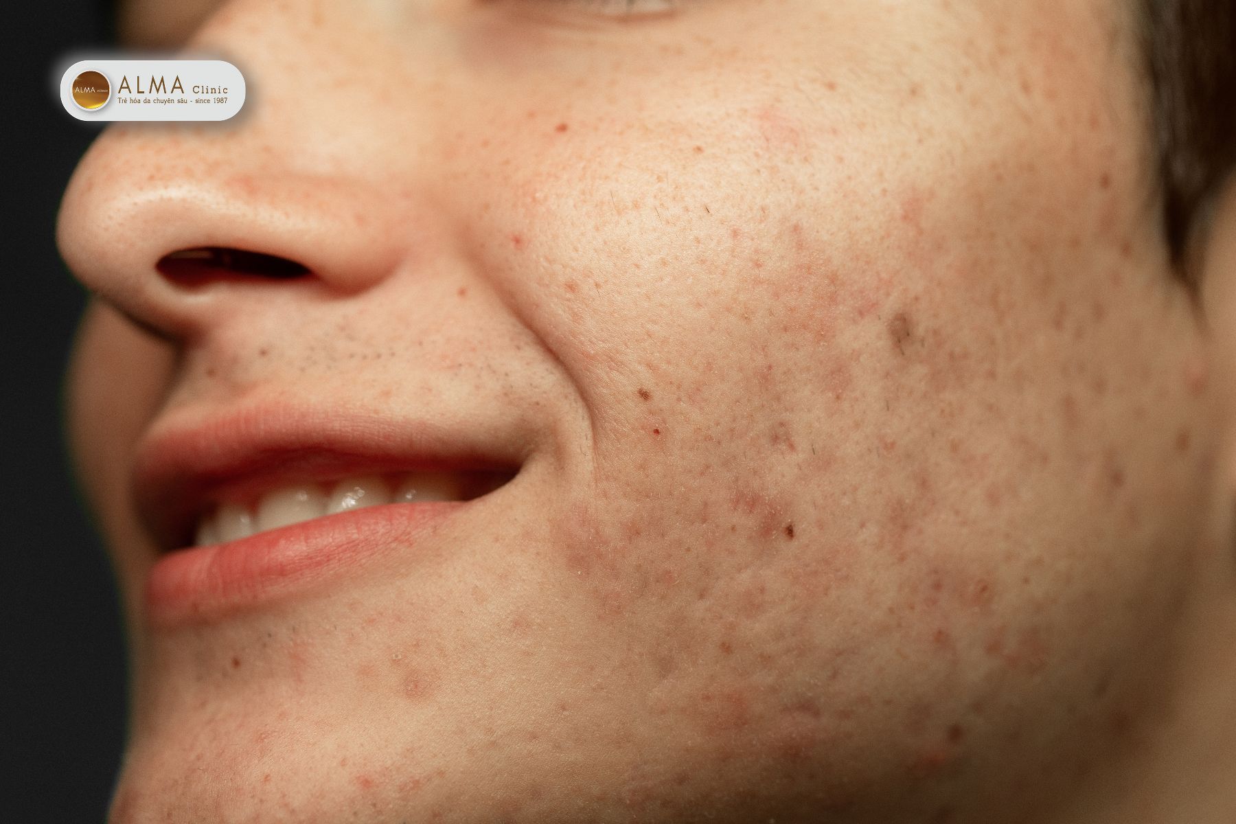 Trị nám bằng kem đánh răng có thể làm trầm trọng hơn tình trạng mụn