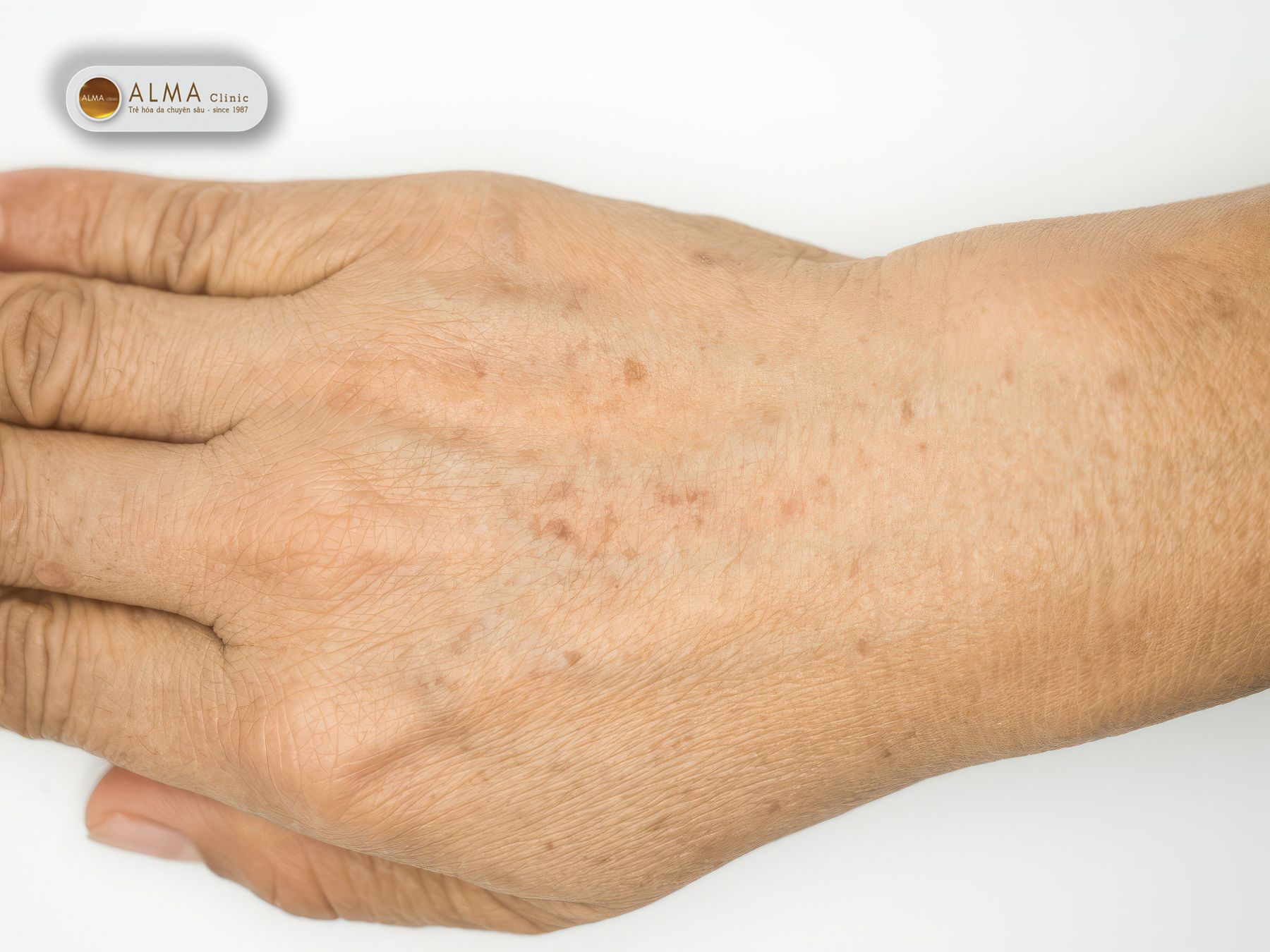 Nam da tay co tu het khong Loi giai dap tu goc nhin khoa hoc Nám da tay có tự hết không? Lời giải đáp từ góc nhìn khoa học