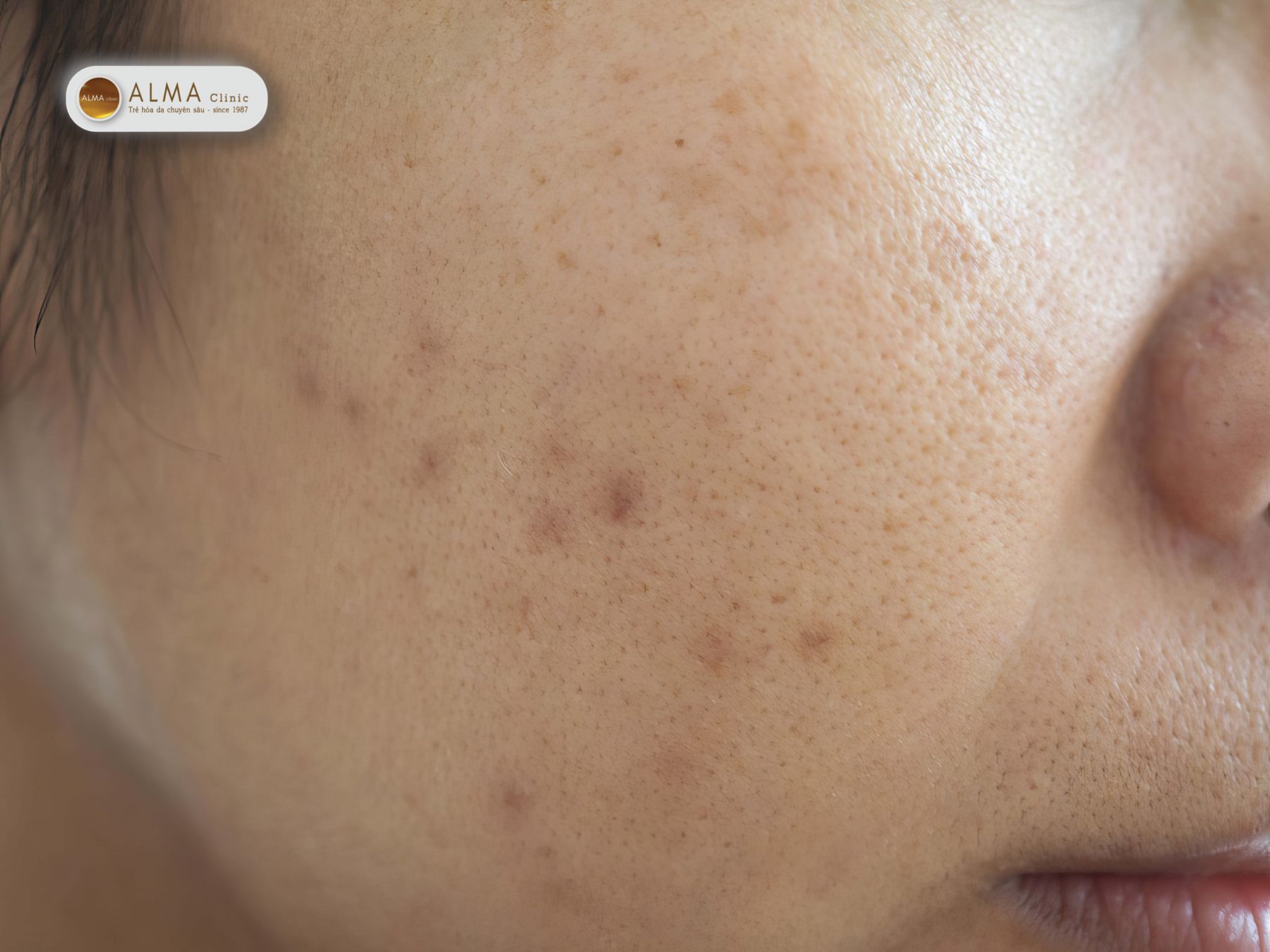 Nhận diện "da bị nám nhẹ": Những dấu hiệu không nên bỏ qua