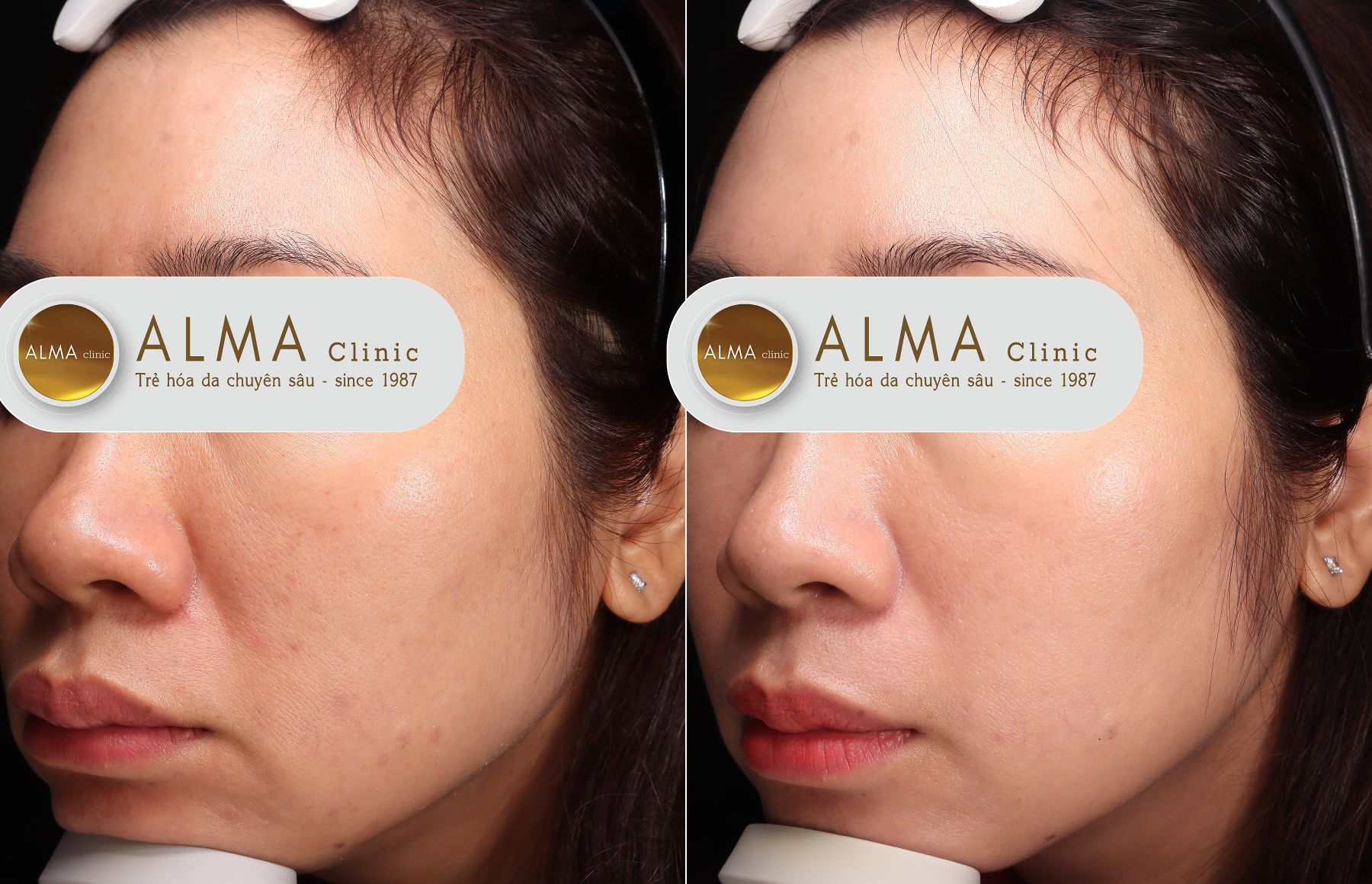 Dieu tri nam bang cong nghe hien dai se mang lai ket qua cao va nhanh hon so voi cach chua nam bang la tia to Điều trị nám bằng công nghệ hiện đại sẽ mang lại kết quả cao và nhanh hơn so với cách chữa nám bằng lá tía tô