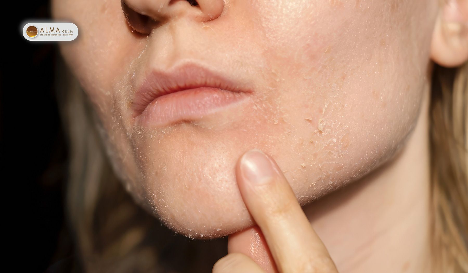 Tác hại khó lường của cách trị nám tại nhà bằng kem trộn