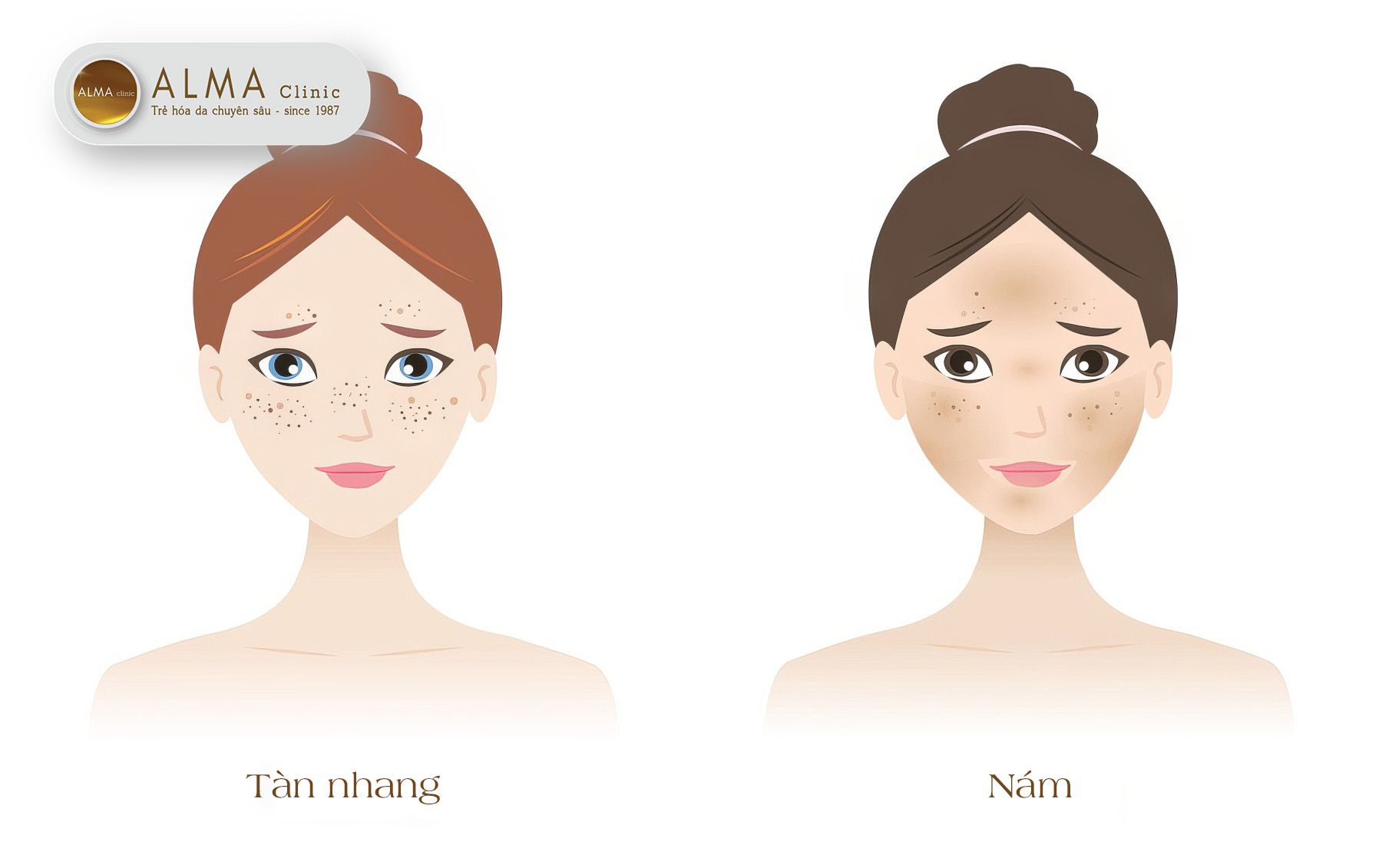 Phân biệt nám và tàn nhang