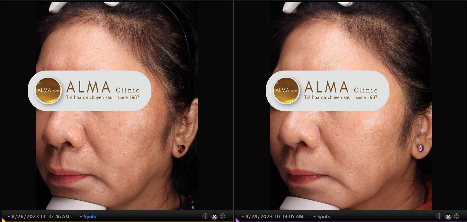 Trải nghiệm khách hàng điều trị nám tàn nhang tại Alma Clinic