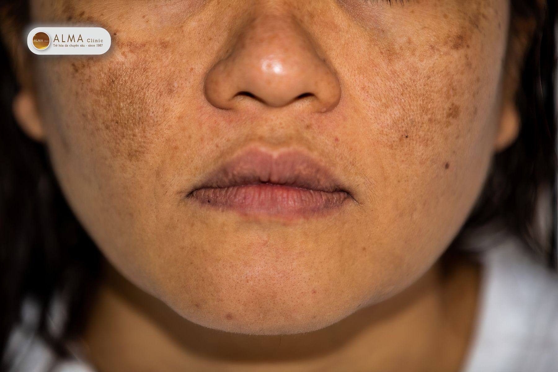 Nám - Cách phân biệt nám tàn nhang đồi mồiNám - Cách phân biệt nám tàn nhang đồi mồi