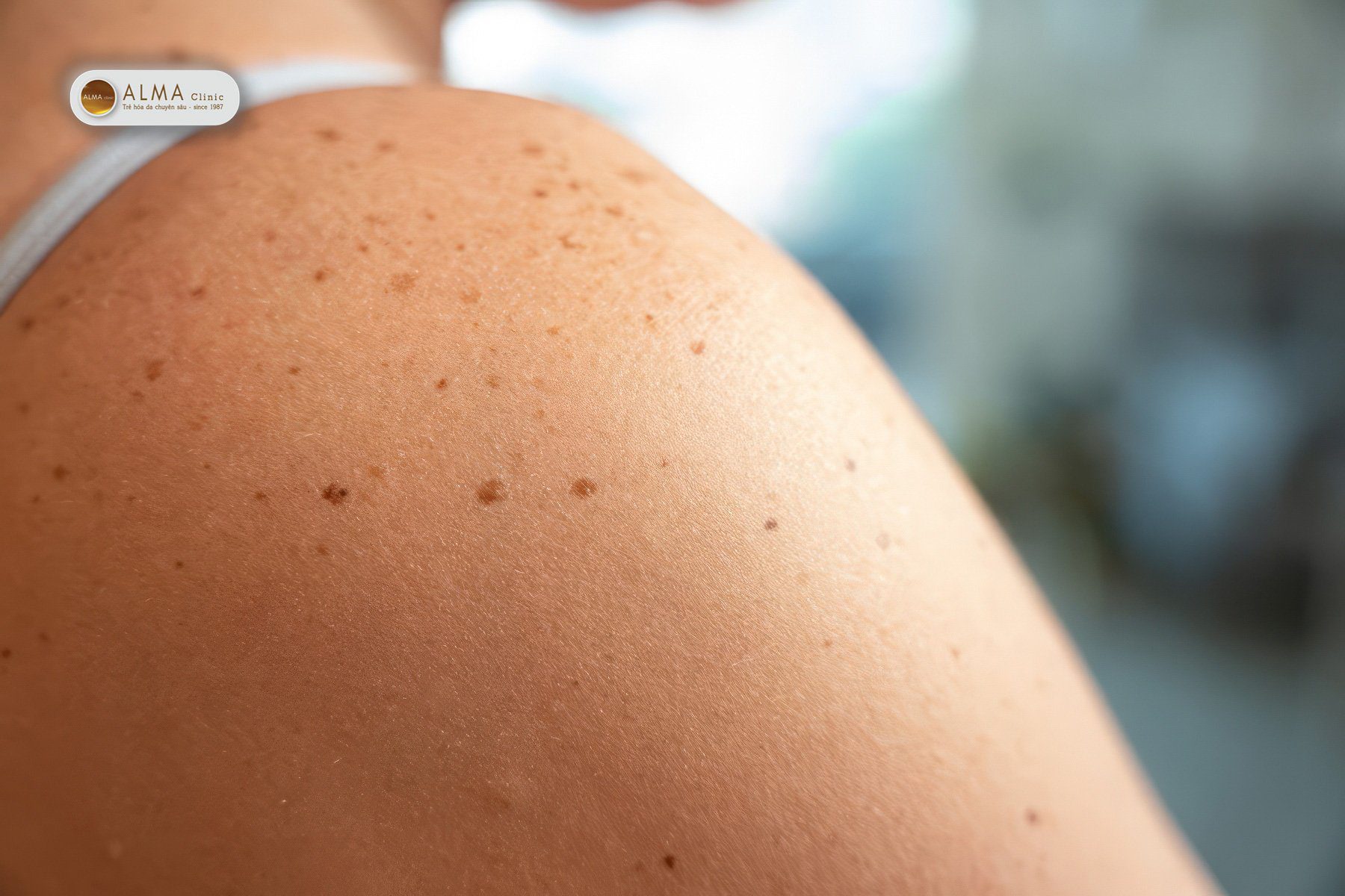 Tàn nhang - Cách phân biệt nám tàn nhang đồi mồi