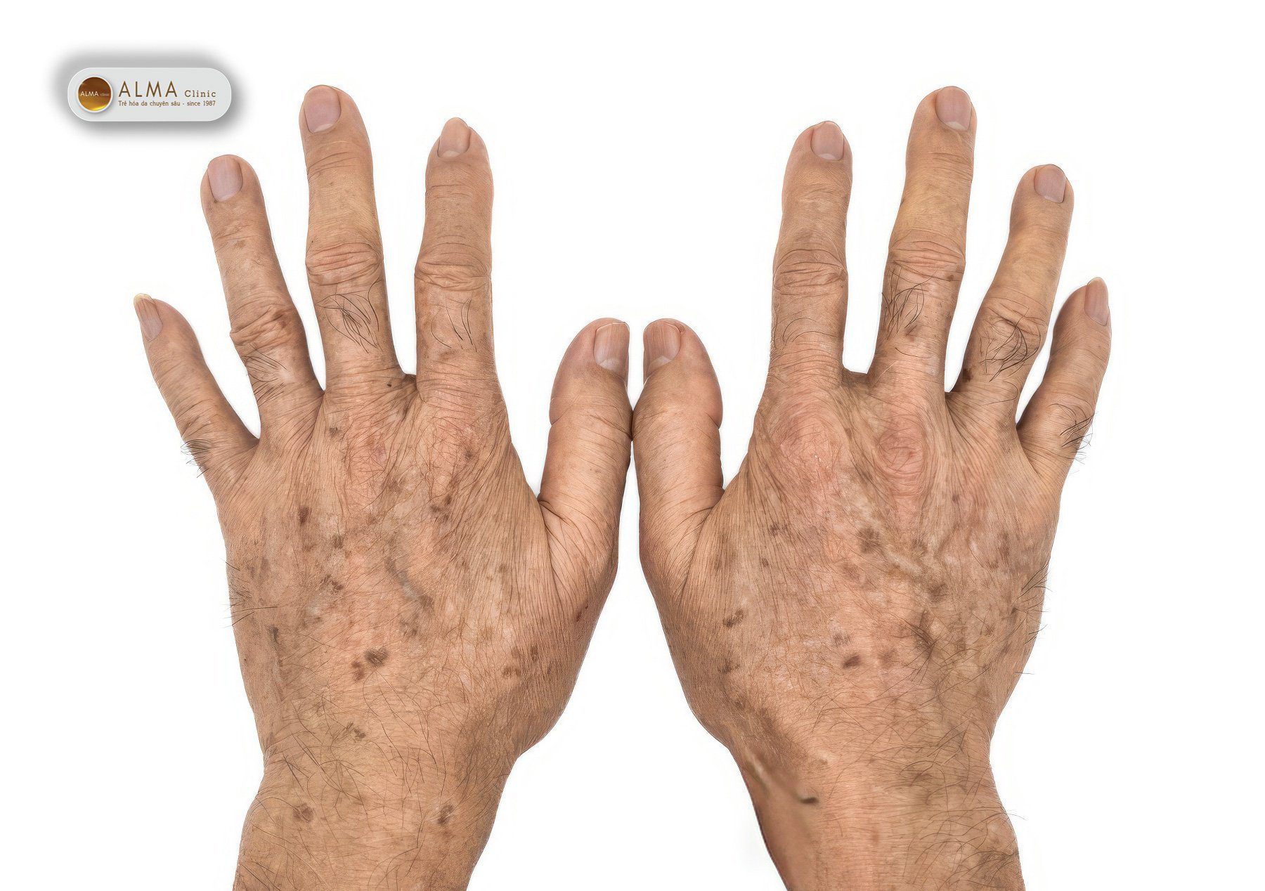 Đồi mồi- Cách phân biệt nám tàn nhang đồi mồi