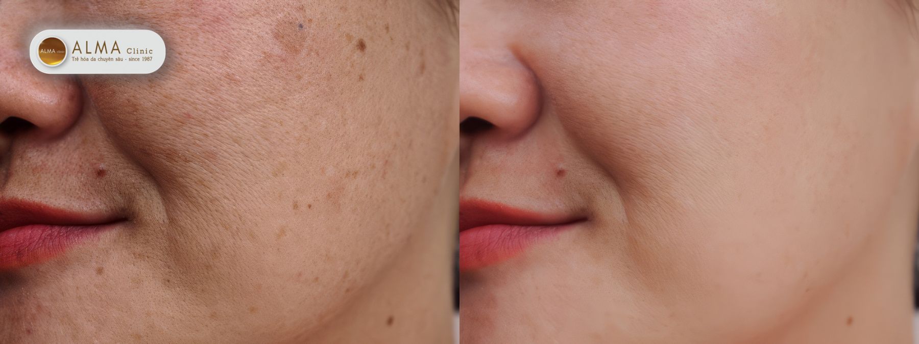 Một câu chuyện trị nám bằng lá tía tô