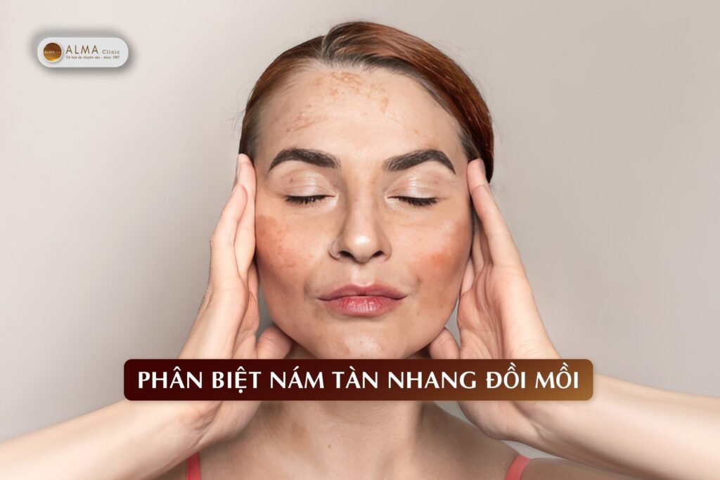 Phân biệt Nám Tàn Nhang Đồi Mồi và điều trị tận gốc