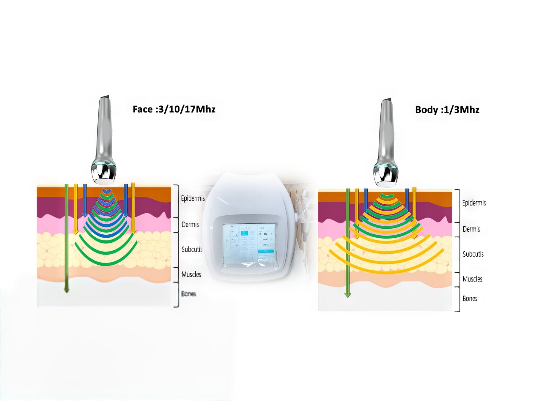 Công nghệ sóng âm tần số kép IDM trong điều trị vết đồi mồi