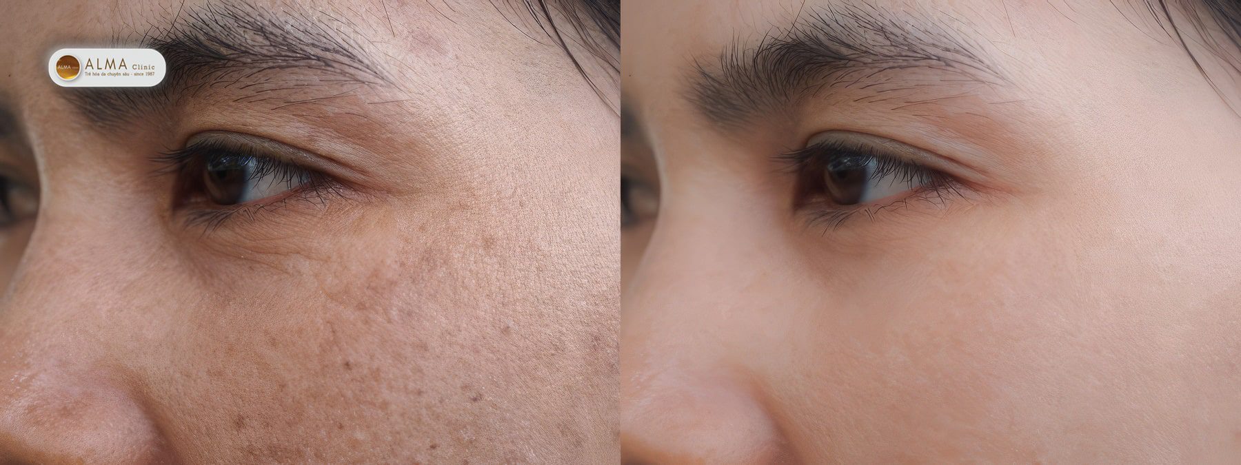 Ket qua xoa dom nau doi Kết quả xóa đốm nâu đồi