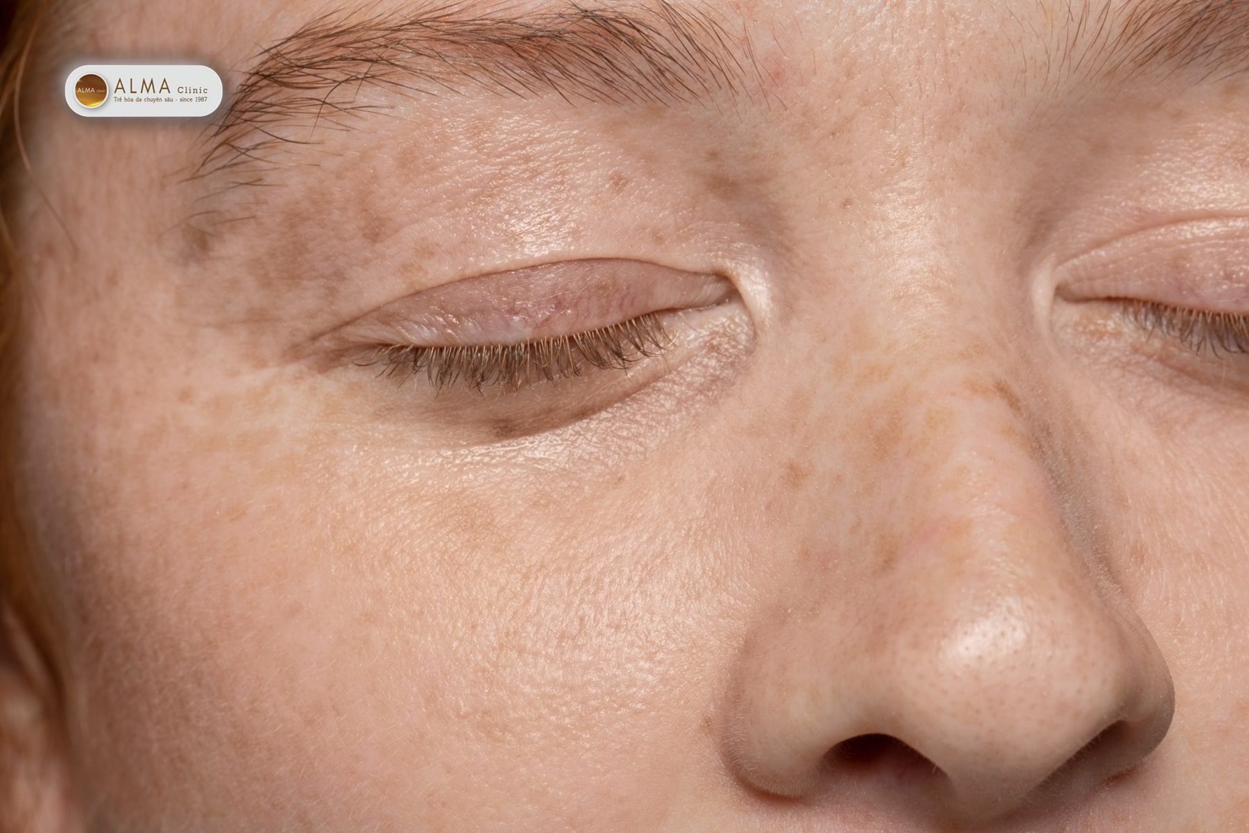 Vết đồi mồi không nguy hiểm, nhưng ảnh hưởng nặng nề đến sự tự tin và cảm xúc.