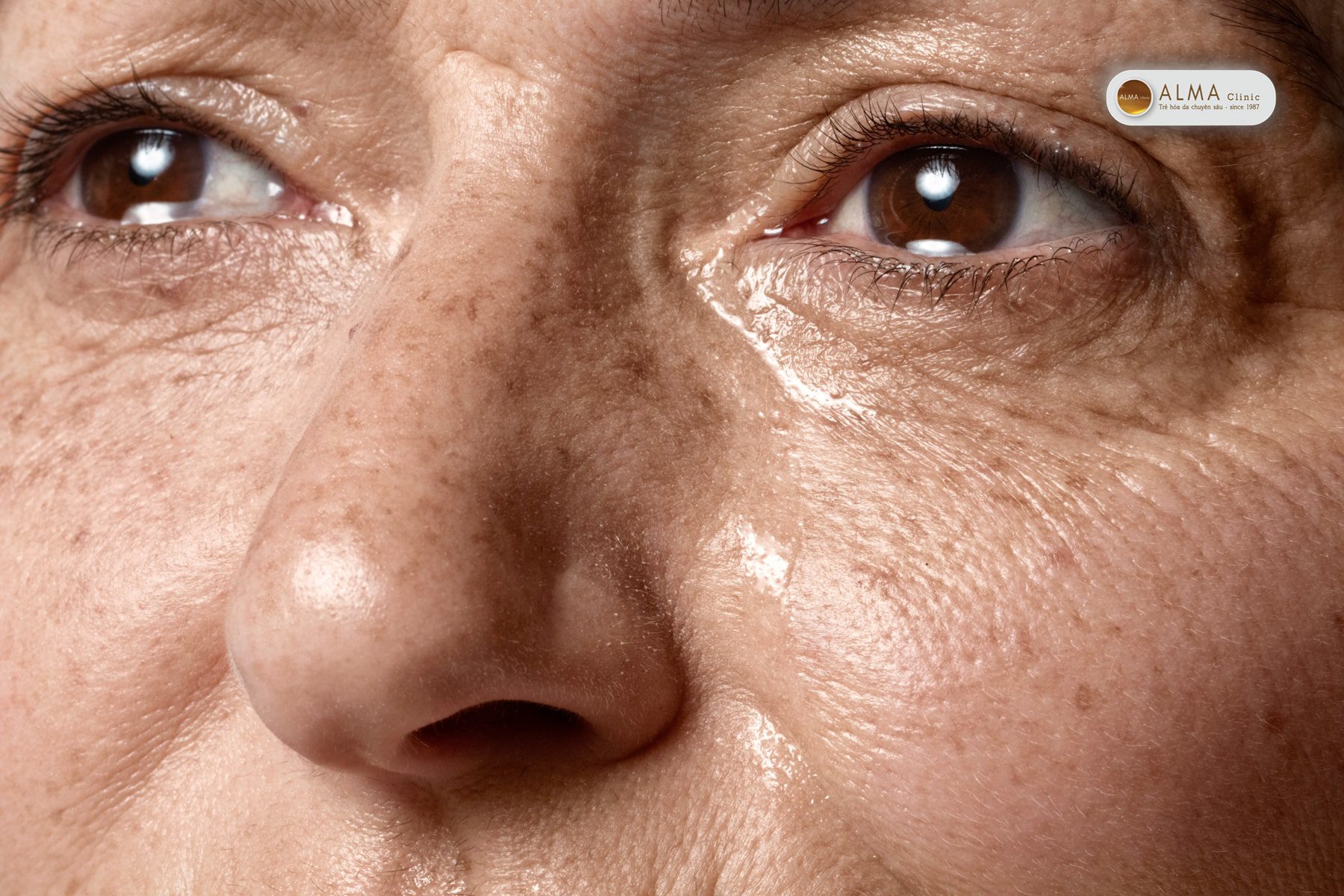 Vì sao phụ nữ sợ vết đồi mồi đến vậy