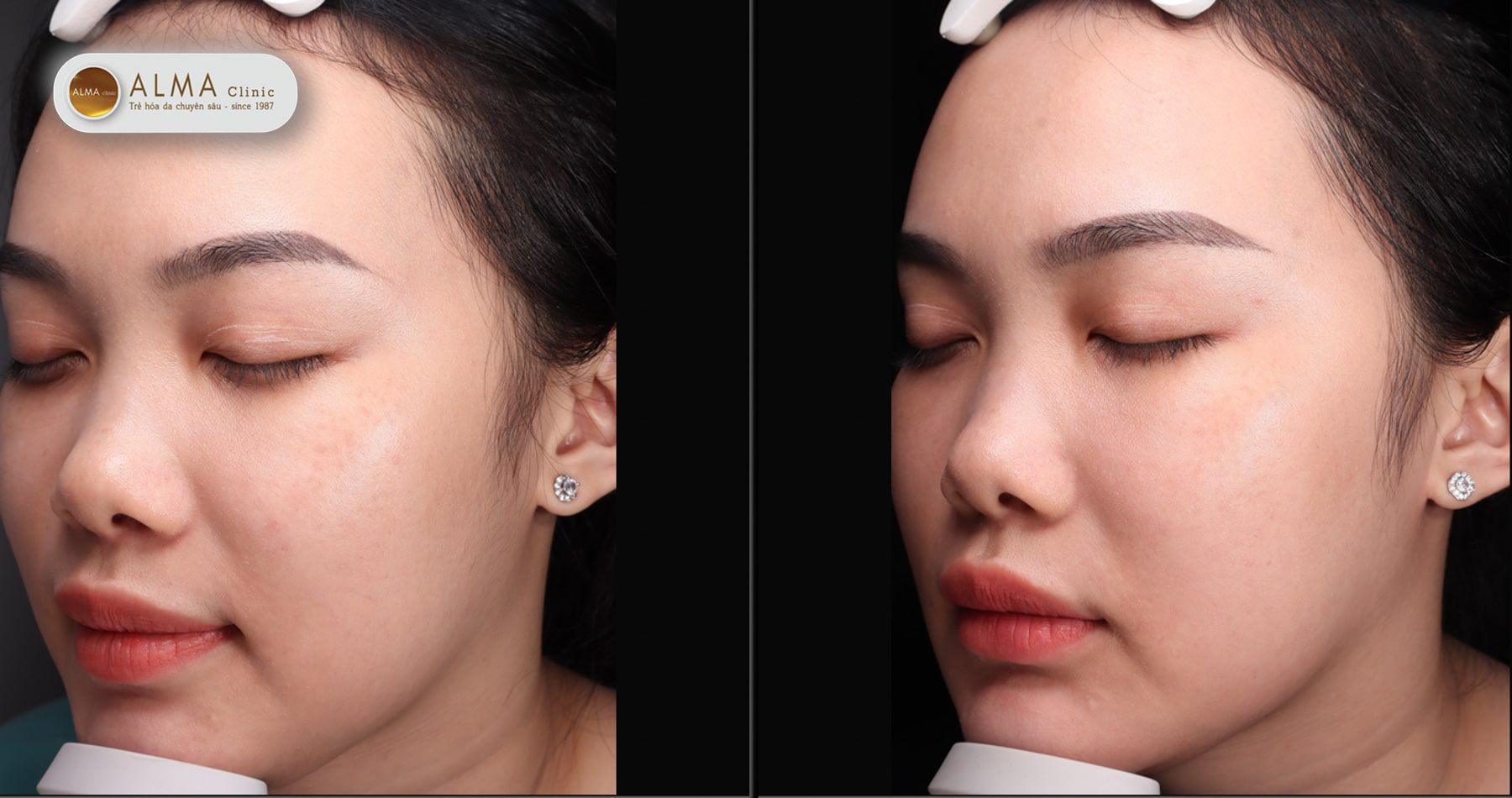 Điều trị nám da sau sinh: Cần đúng thời điểm và đúng cách