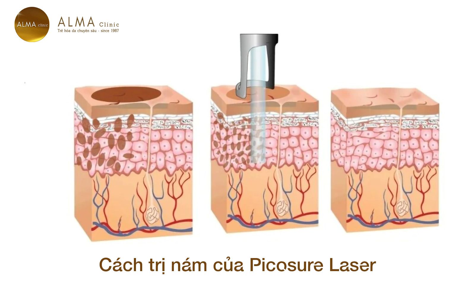 Trị nám bằng laser: Khi công nghệ chỉ hiệu quả nếu được đặt đúng chỗ