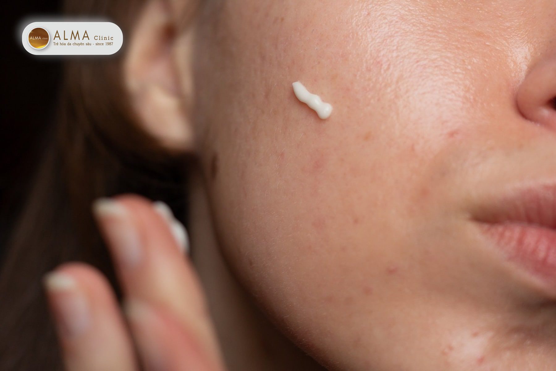 Vì sao dùng đúng các hoạt chất trị nám vẫn có thể thất bại?