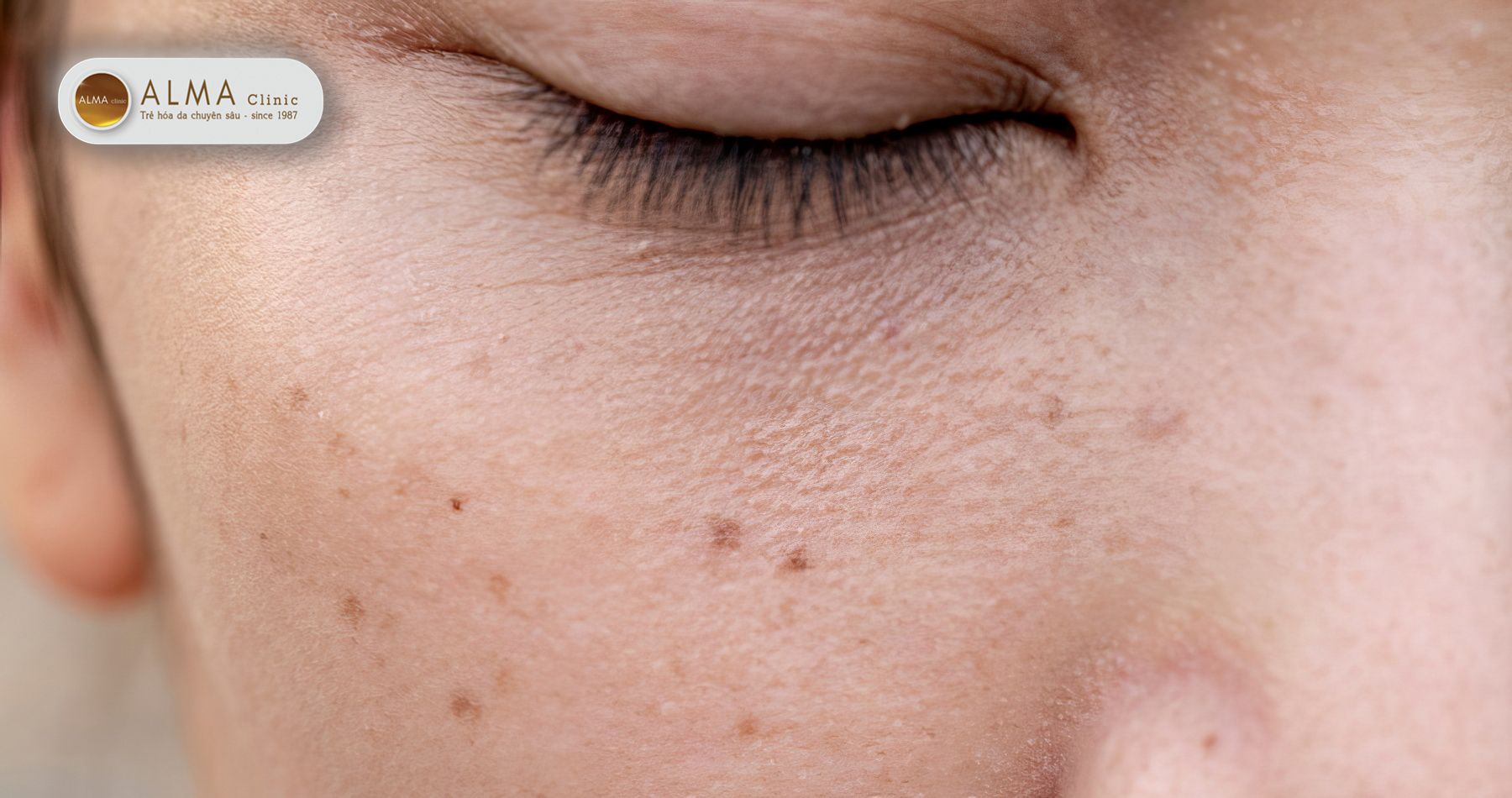 Vì sao trị nám đúng phương pháp vẫn tái phát?