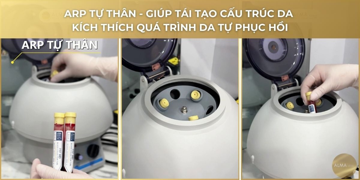 PRP tự thân tái tạo cấu trúc da