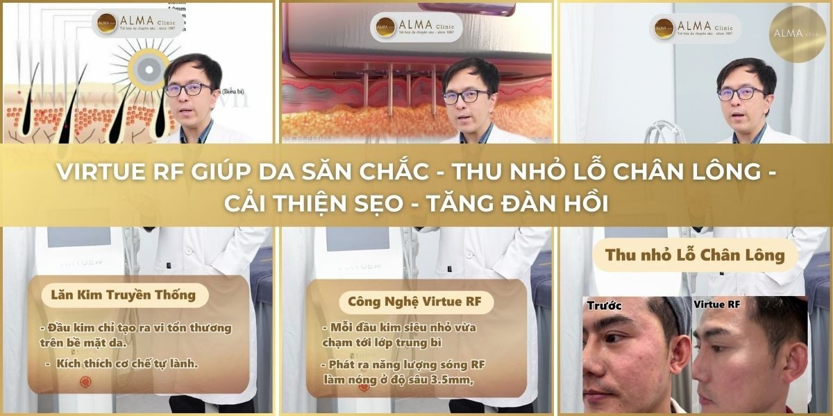 Trẻ hóa da cùng Virtue RF tại Alma