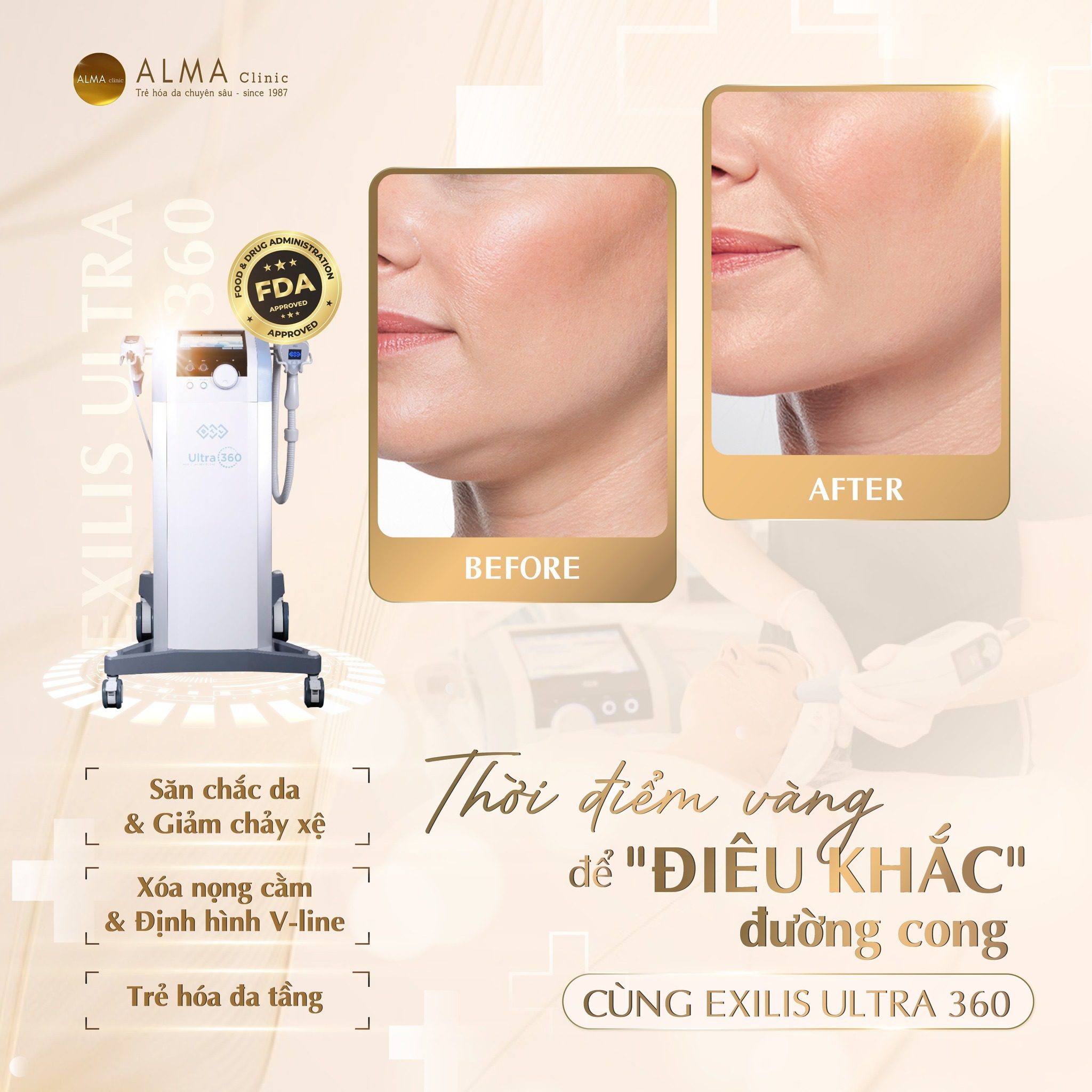 Kết quả thon gọn mặt và body bằng Exilis
