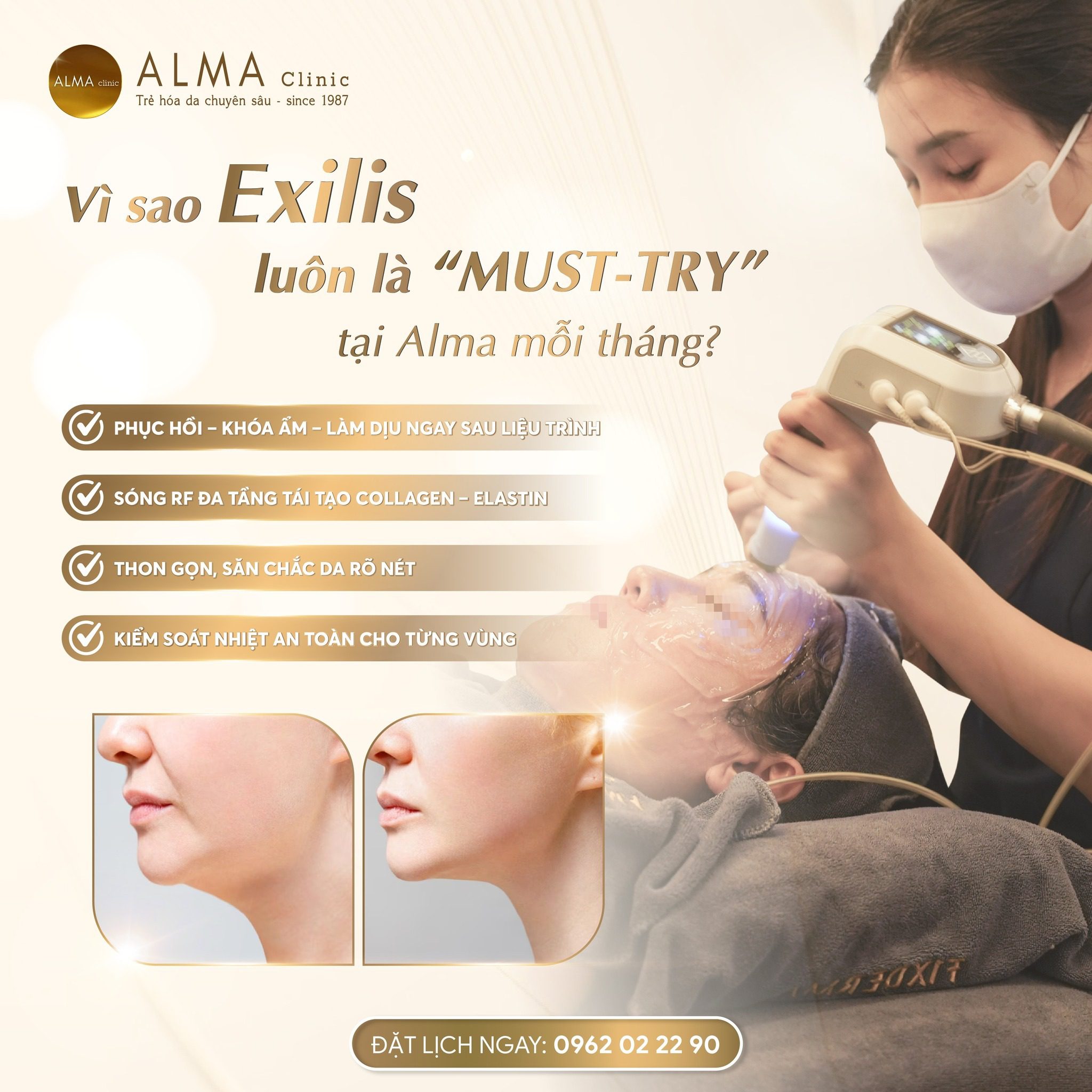 Ưu điểm của công nghệ Exilis