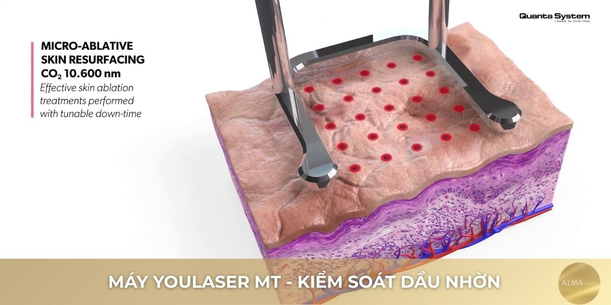 Thông số kỹ thuật You Laser MT