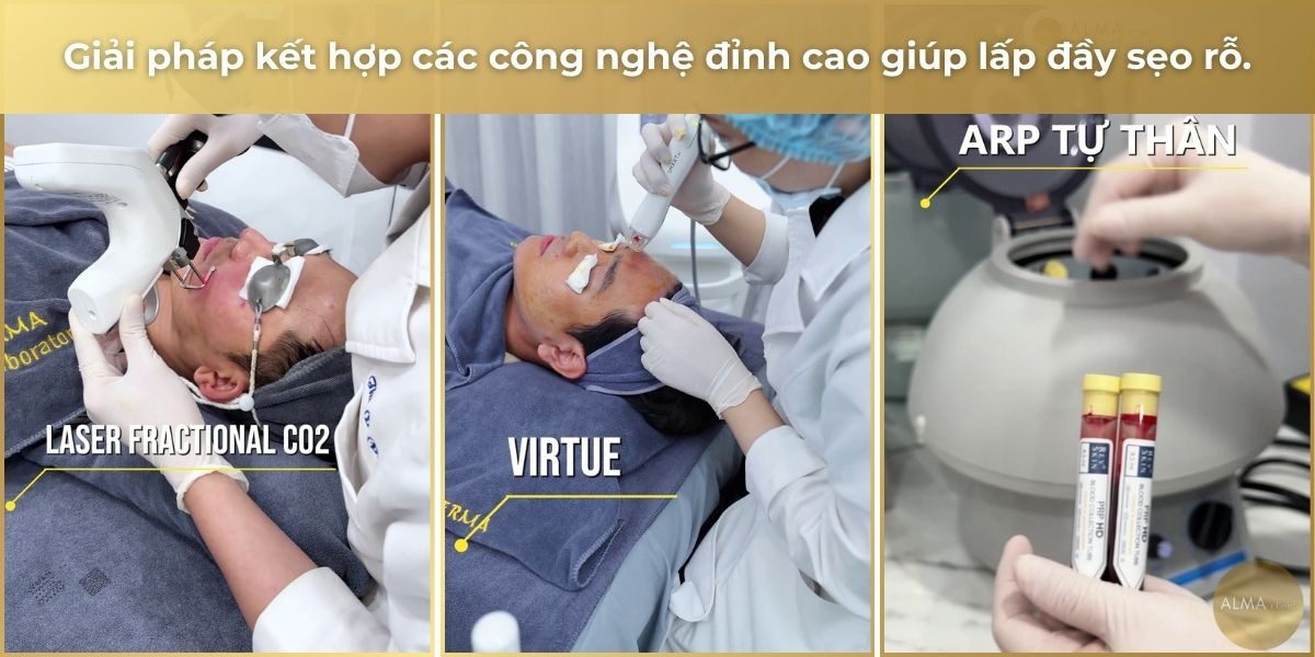 Giải pháp kết hợp công nghệ lấp đầy sẹo rỗ