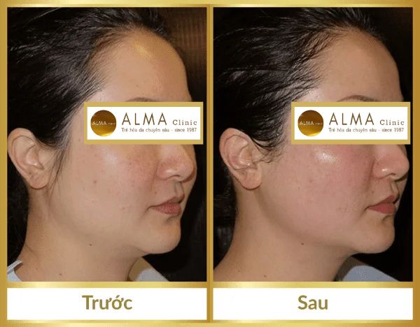 Phòng khám da liễu ALMA CLINIC ket qua dieu tri truoc va sau tai alma clinic 1