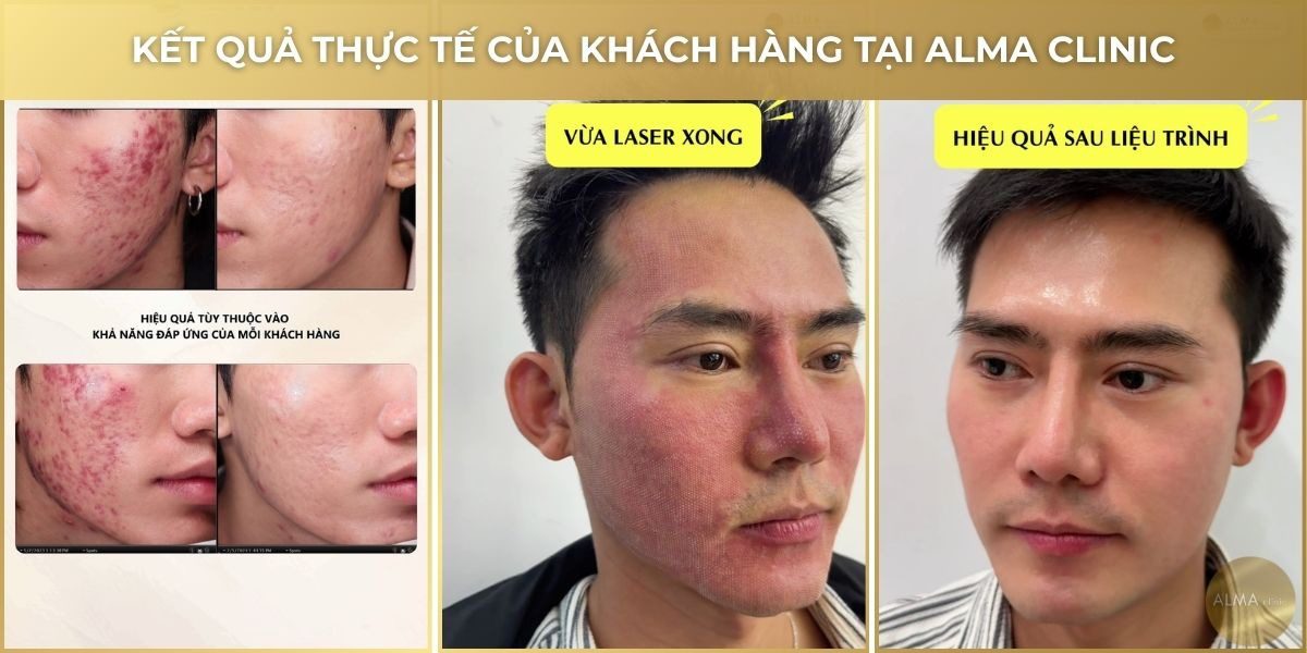 ket qua thuc te dieu tri seo ro alma clinic Hình ảnh trước và sau khi điều trị sẹo rỗ tại Alma Clinic cho thấy làn da được lấp đầy và mịn màng rõ rệt.