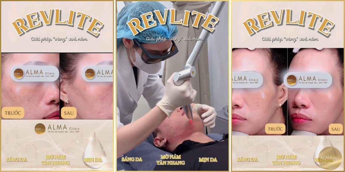 Kết quả điều trị nám và tàn nhang bằng công nghệ Laser Revlite tại Alma Clinic - Trước và sau liệu trình.