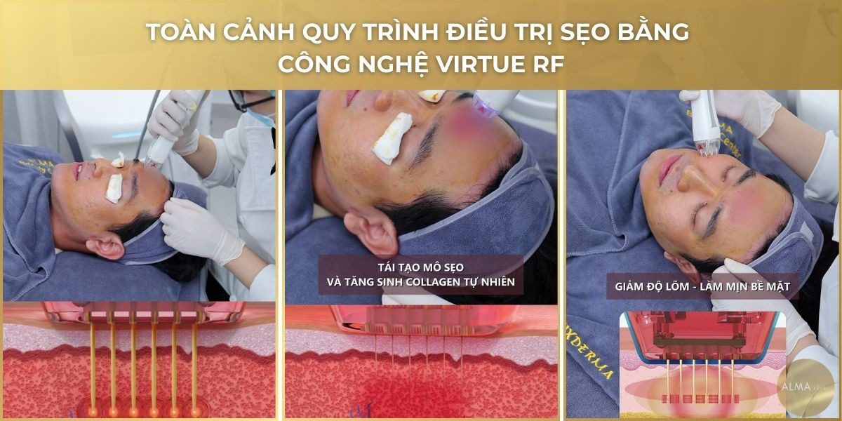 Quy trình điều trị sẹo Virtue RF