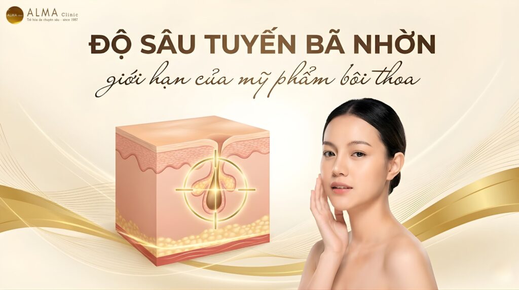 Tuyến Bã Nhờn Nằm Ở Đâu? Bước Sóng 1726nm Tiếp Cận Thế Nào?
