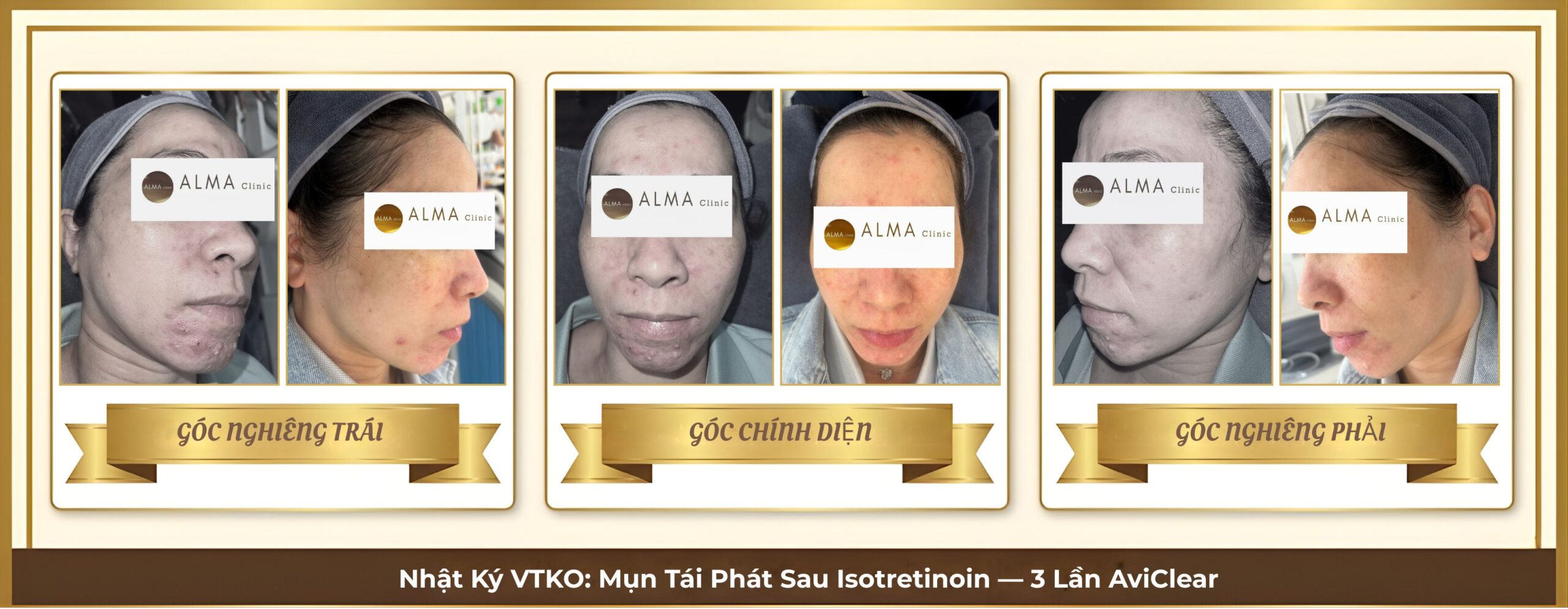 Hành trình lâm sàng VTKO — mụn viêm nặng tái phát sau ngưng Isotretinoin yếu tố nội tiết, 3 buổi AviClear 1726nm giảm rõ ổ viêm cằm hàm. Ảnh 3 góc tuần tự. 