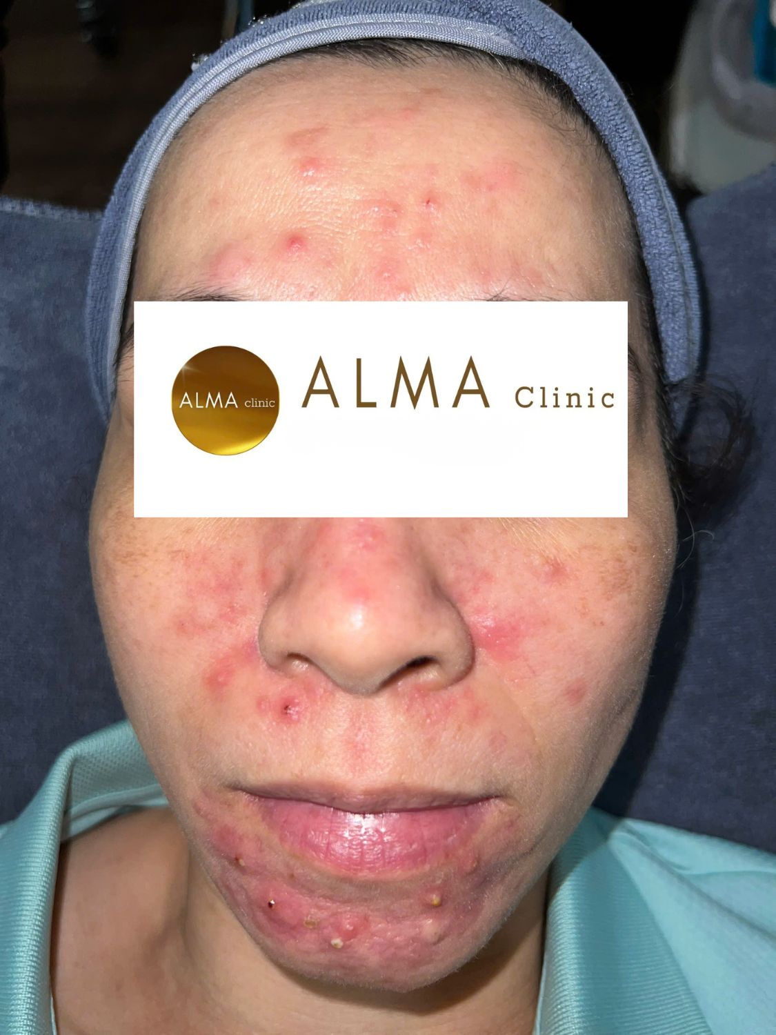 Phòng khám da liễu ALMA CLINIC 1 CASE 06 GOC CD TEN VTKO lan 1 NGAY 251125